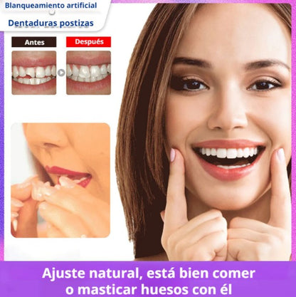 Carillas Dentales Snap On Smile®